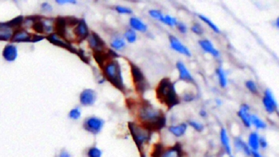 Individuata la firma genetica del più aggressivo tumore del pancreas