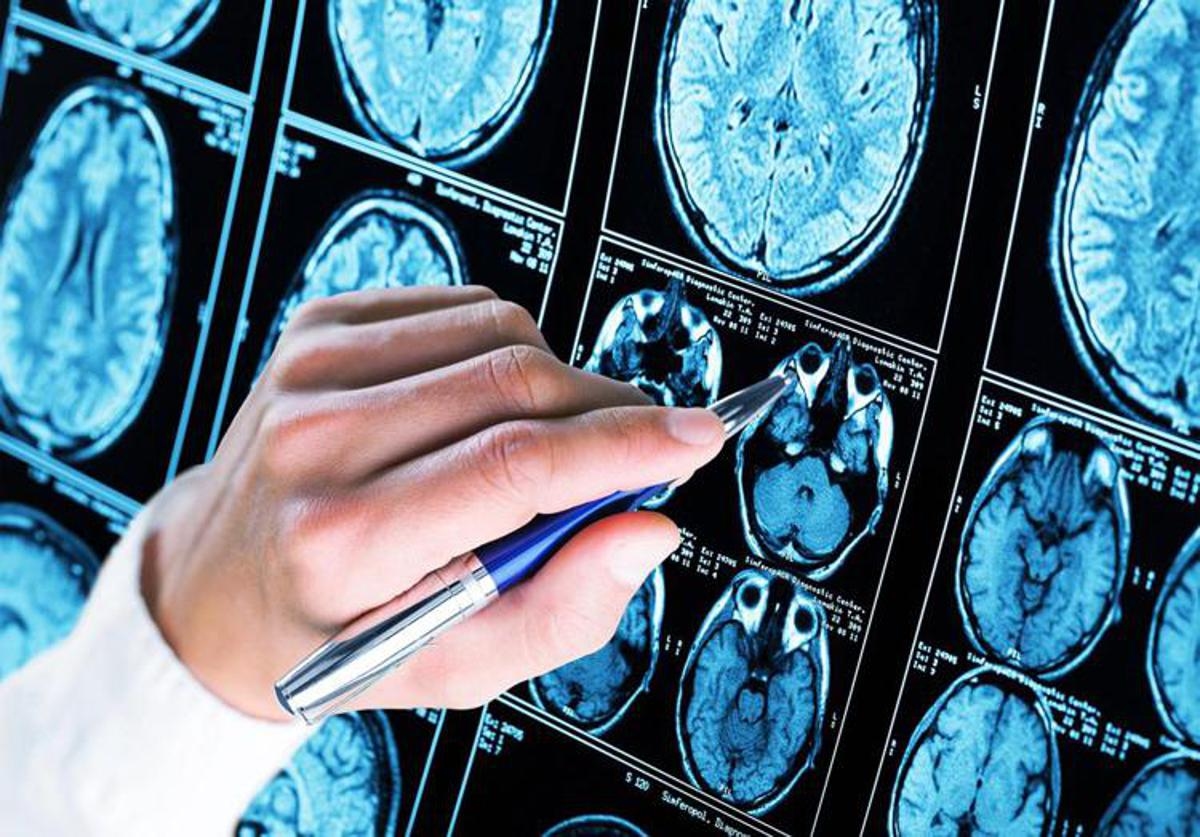 Demenze, machine learning e algoritmi per prevedere l’insorgenza dell’Alzheimer