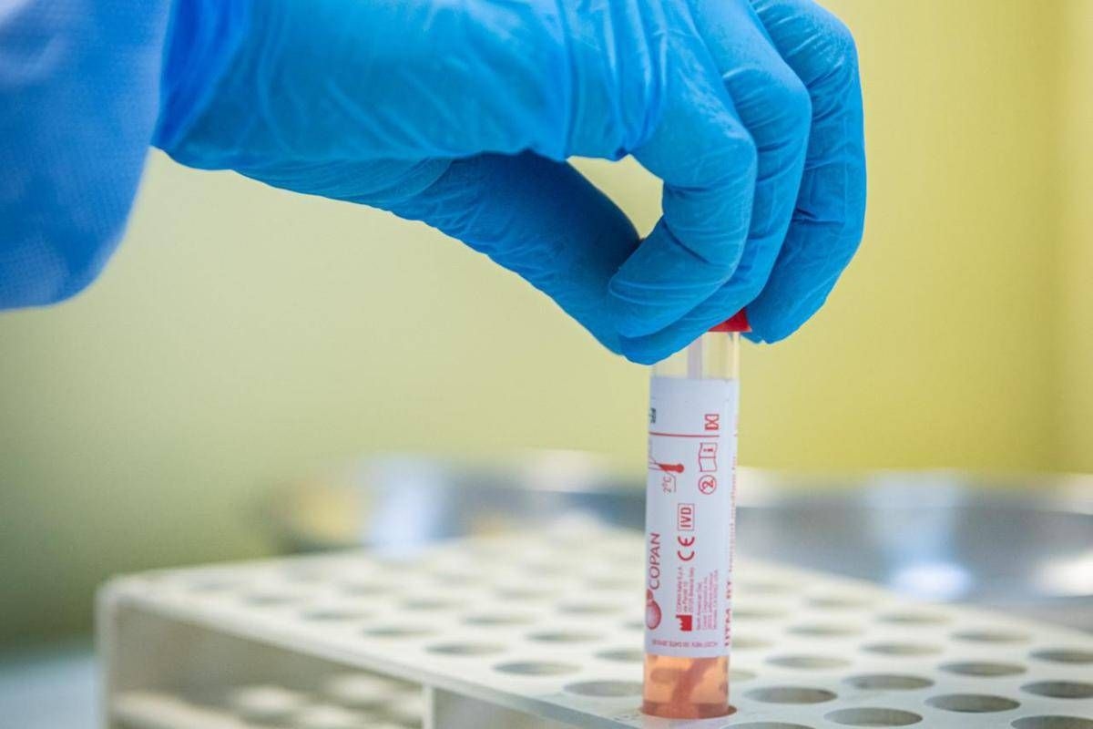 Ricerca, svelata la genetica del Long Covid: una variante aumenta il rischio del 60%