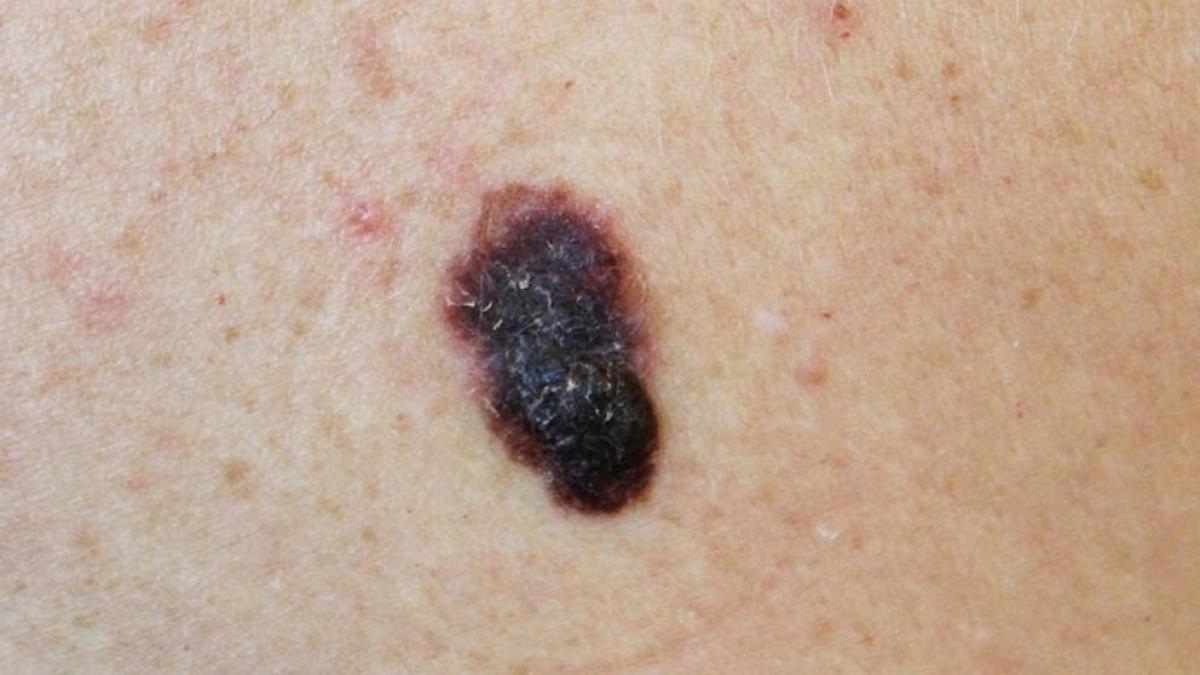 Melanoma: o que é, como prevenir e tratar esse tipo de câncer de pele