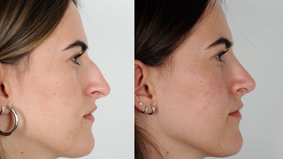Ultraschall-Rhinoplastik, der Schlüssel zur Nasenästhetik