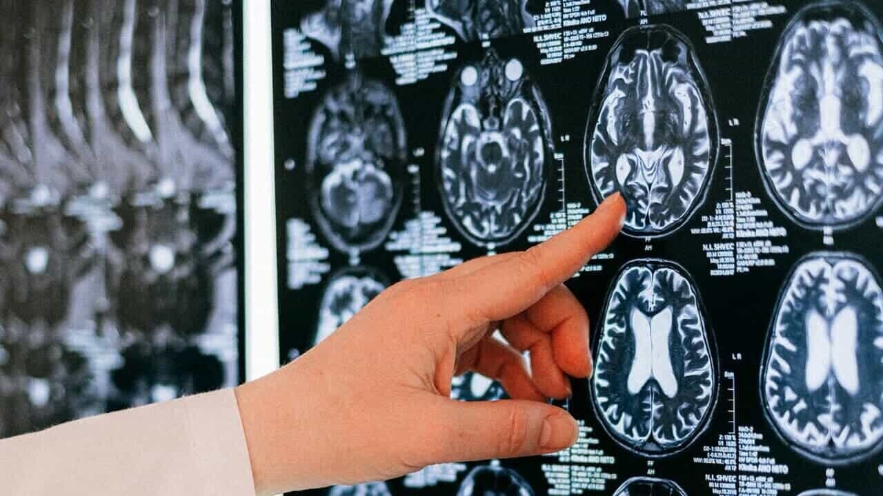O Alzheimer é diagnosticado por meio de um exame de sangue