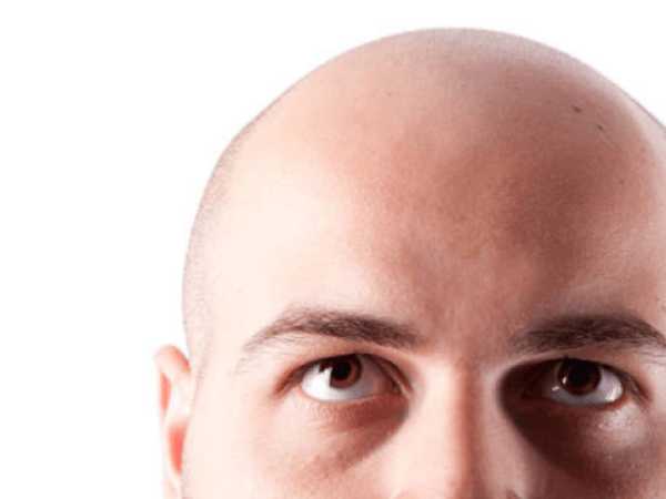 Colombia was on the list: the areas in the world with the most bald people