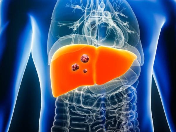 El examen que permite identificar el cáncer de hígado antes de que aparezcan síntomas