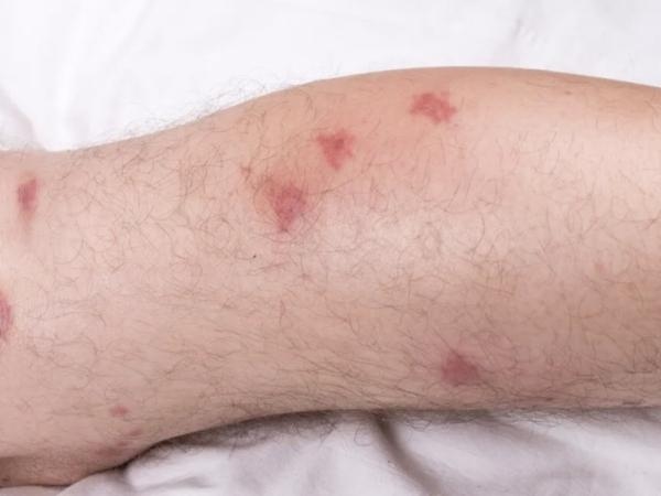 ¿Cuál es el órgano que afecta el mal de Chagas? Así le daña esta enfermedad