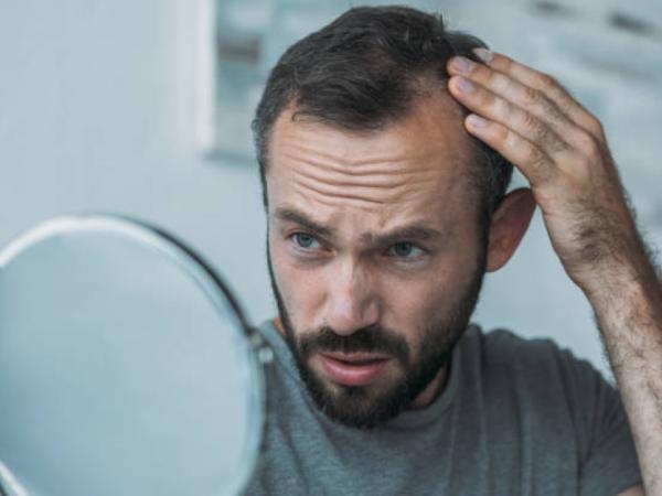 Nicht nur Stress: 6 Gründe, warum Sie eine Glatze bekommen könnten