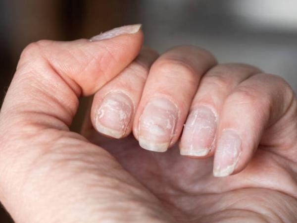 Vos ongles peuvent vous indiquer que vous êtes malade : comment le savoir ?