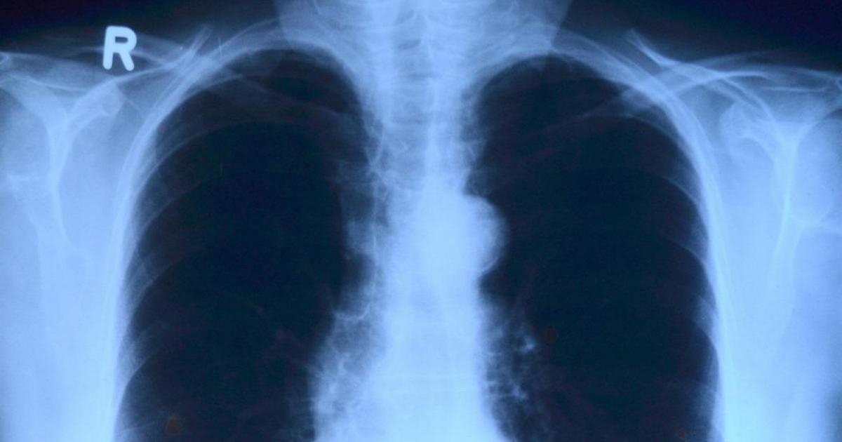 Tumore, Alarmglocken läuten: Bis 2050 wird die Zahl der Krebstoten auf über 18 Millionen steigen, ein Anstieg um 75 %.