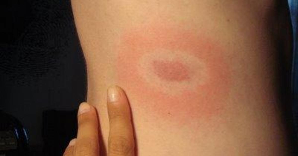 Doença de Lyme: como é contraída, seu curso e tratamentos