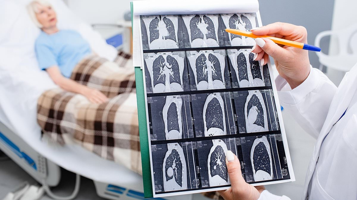 „Czułam niewiarygodny ból… lekarz powiedział, że to tylko dyskomfort związany z karmieniem piersią”: Gini była niepalącą osobą, której ból barku przysporzył męki. W końcu odkryła, że to rak płuc. Teraz nasz ekspert ujawnia ukryte objawy choroby.