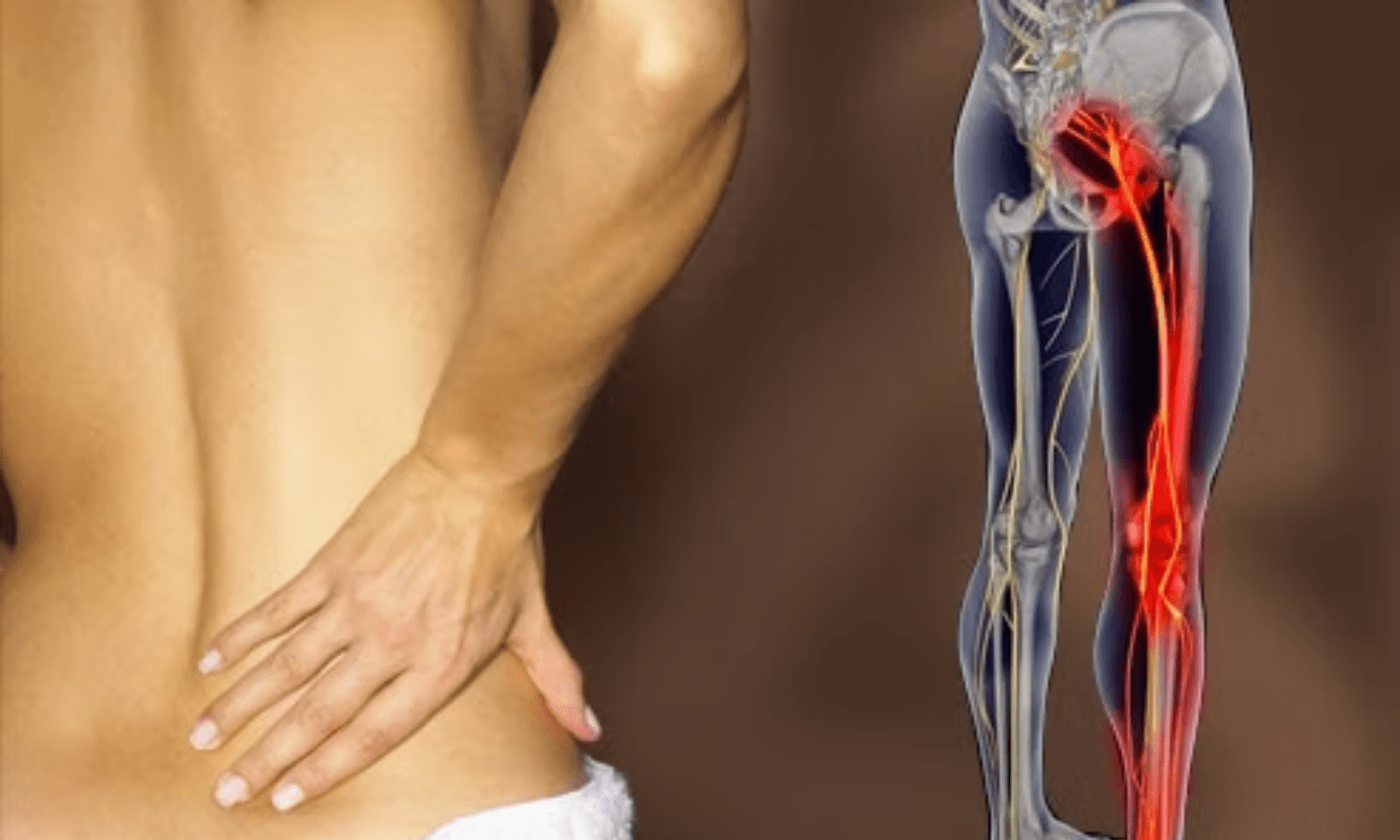 Douleur sciatique : comment l’identifier, quelles en sont les causes et comment la soulager