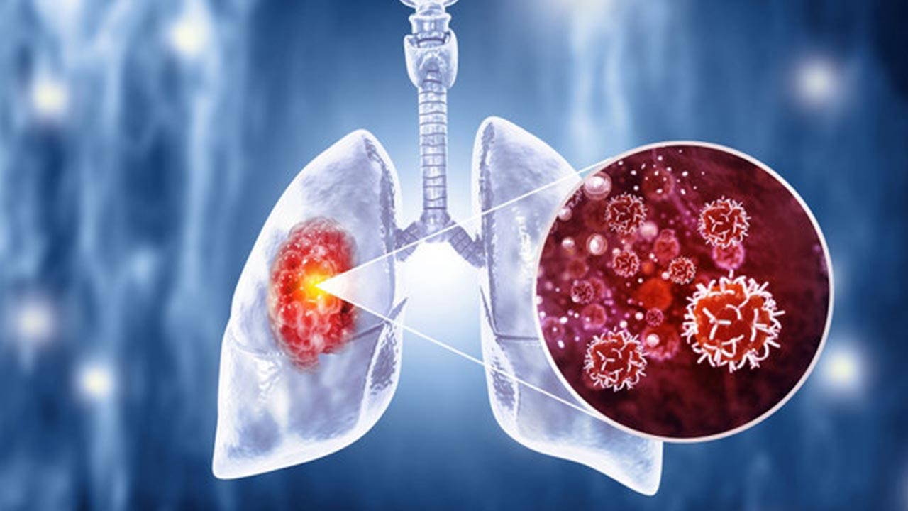 Эксперт предупредил: «Питание влияет на иммунитет при раке легких»